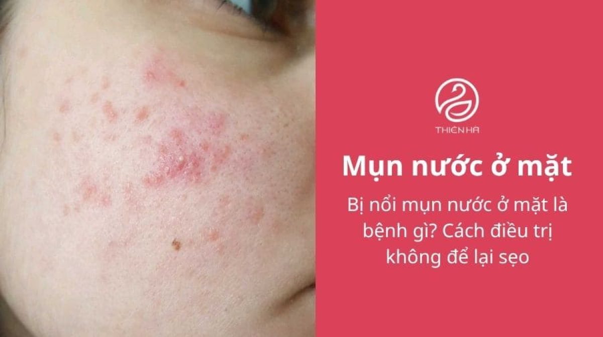 Bị nổi mụn nước ở mặt là bệnh gì? Cách điều trị không để lại sẹo