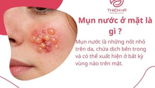 Tất tần tật về mụn nước ở mặt: Nguyên nhân, dấu hiệu & cách điều trị