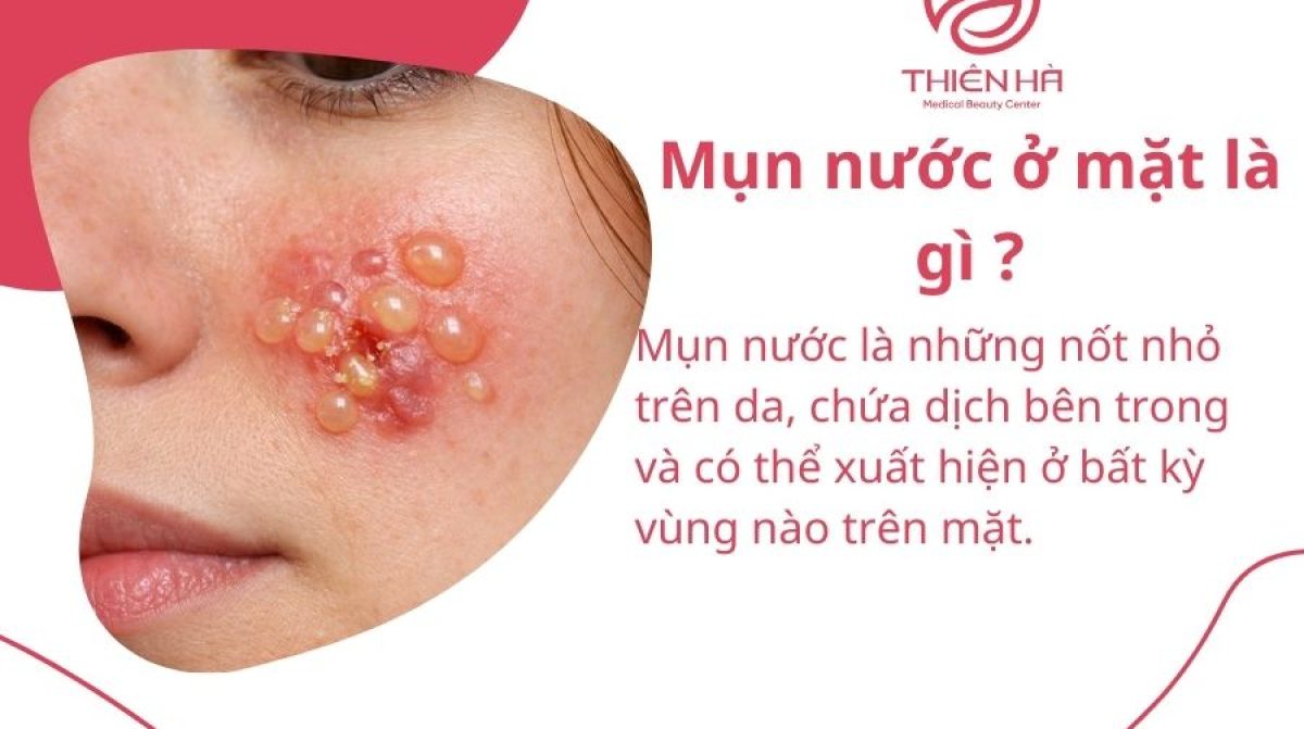 Tất tần tật về mụn nước ở mặt: Nguyên nhân, dấu hiệu & cách điều trị