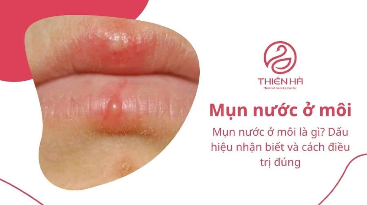 Mụn nước ở môi là gì? Dấu hiệu nhận biết và cách điều trị