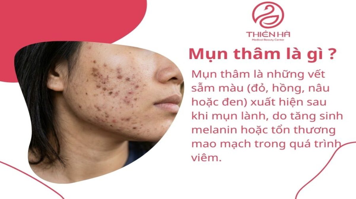 Mụn thâm là gì? Tất cả thông tin bạn cần biết để xử lý đúng cách
