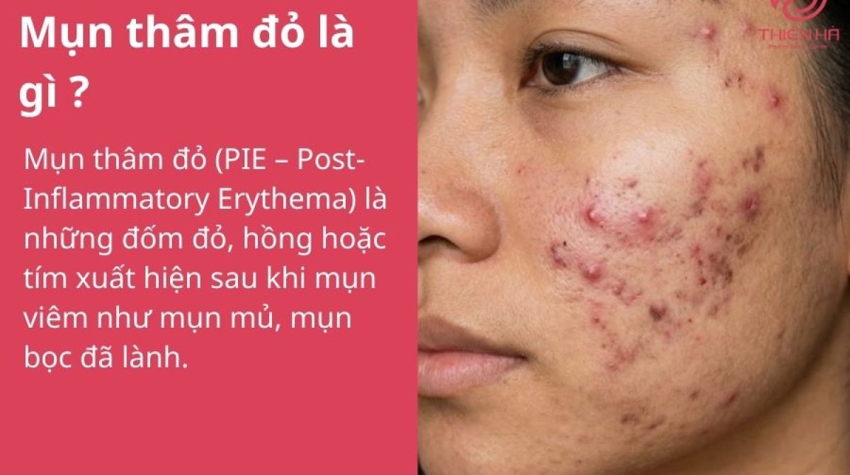 Mụn thâm đỏ là gì? Nguyên nhân và cách xử lý hiệu quả nhanh chóng