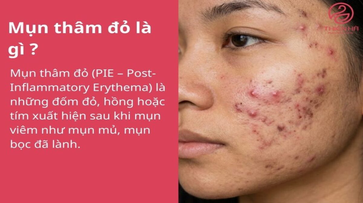 Mụn thâm đỏ là gì? Nguyên nhân và cách xử lý hiệu quả nhanh chóng