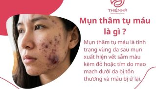 Mụn thâm tụ máu: Nguyên nhân, cách điều trị và lưu ý phòng ngừa tái phát