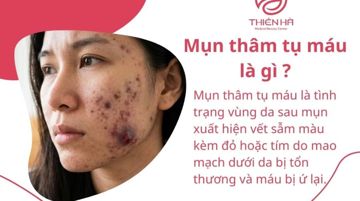 Mụn thâm tụ máu: Nguyên nhân, cách điều trị và lưu ý phòng ngừa tái phát