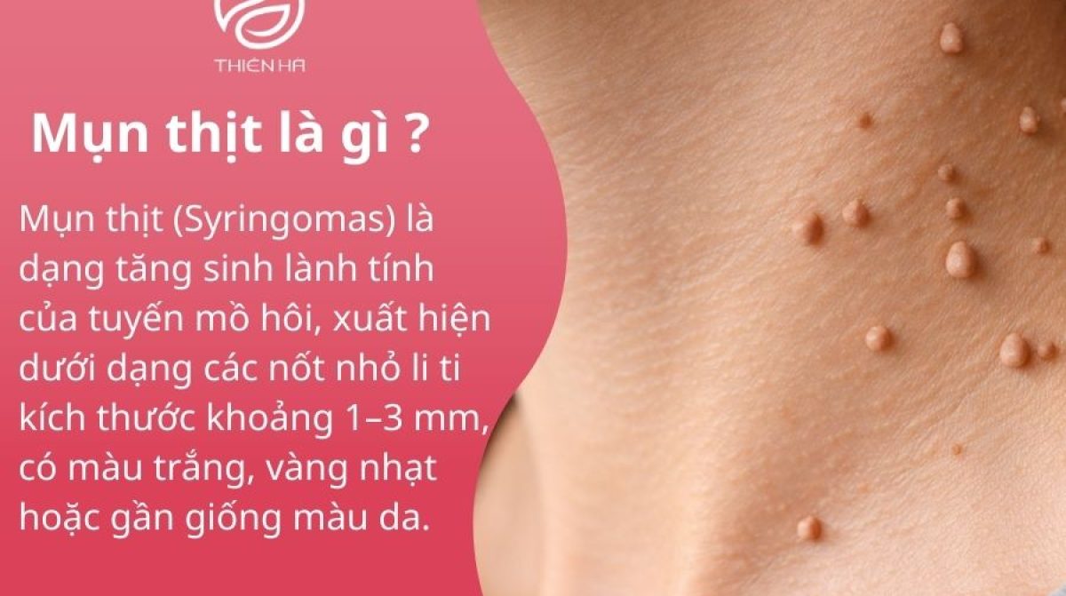 Mụn thịt: Nguyên nhân hình thành và cách loại bỏ an toàn, không sẹo