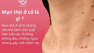 Mụn nội tiết ở cằm là gì? Cách nhận biết và xử lý hiệu quả