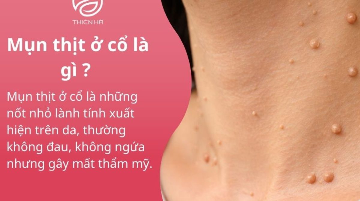Mụn nội tiết ở cằm là gì? Cách nhận biết và xử lý hiệu quả