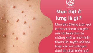Mụn thịt ở lưng: Dấu hiệu, nguyên nhân và cách điều trị an toàn hiện nay