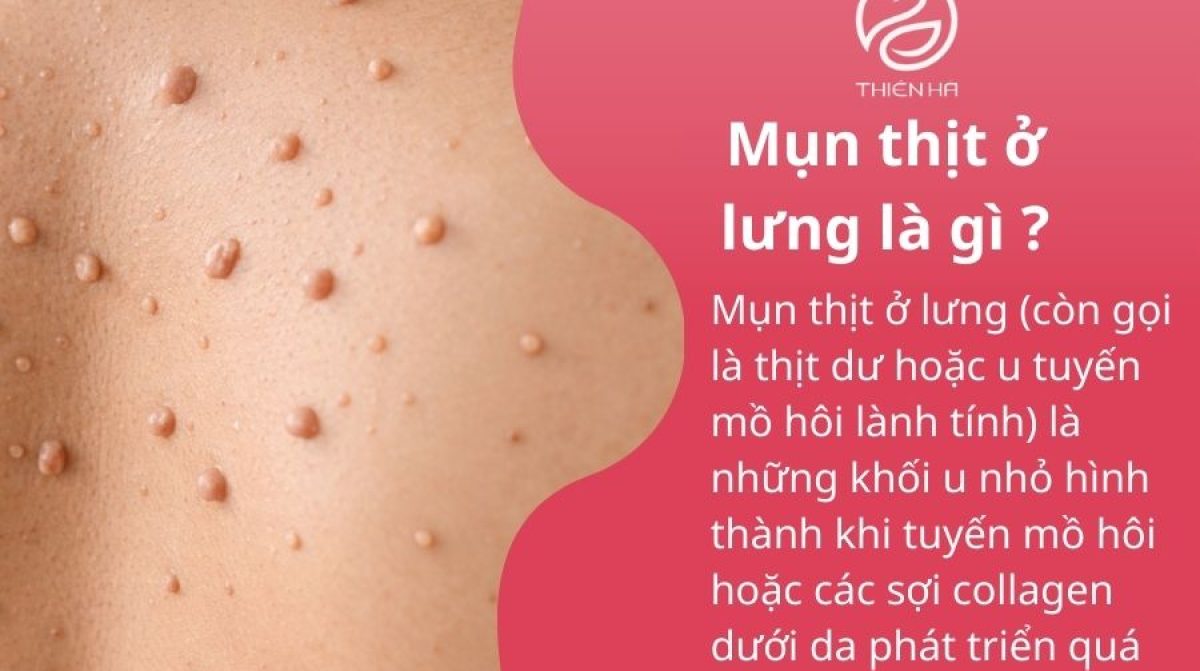 Mụn thịt ở lưng: Dấu hiệu, nguyên nhân và cách điều trị an toàn hiện nay