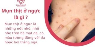 Mụn thịt ở ngực là gì? Nguyên nhân và phương pháp điều trị hiệu quả