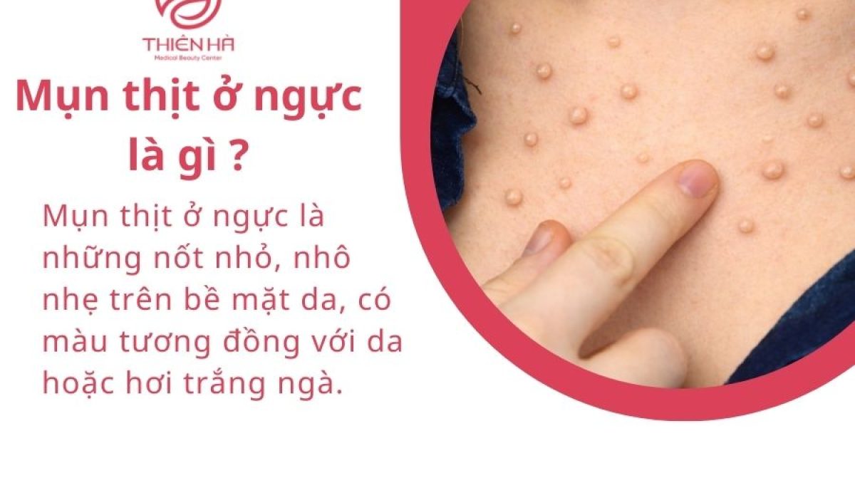 Mụn thịt ở ngực là gì? Nguyên nhân và phương pháp điều trị hiệu quả