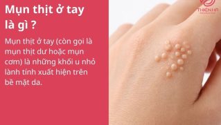 Mụn thịt ở tay: Nguyên nhân, cách nhận biết và phương pháp điều trị hiệu quả