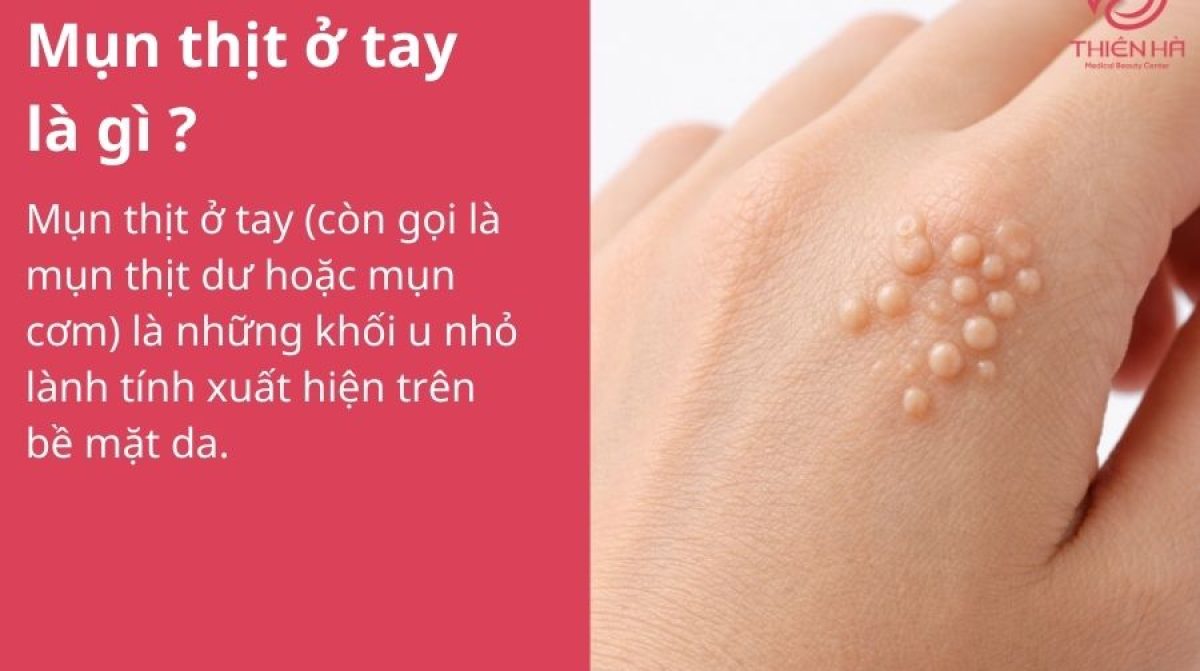Mụn thịt ở tay: Nguyên nhân, cách nhận biết và phương pháp điều trị hiệu quả