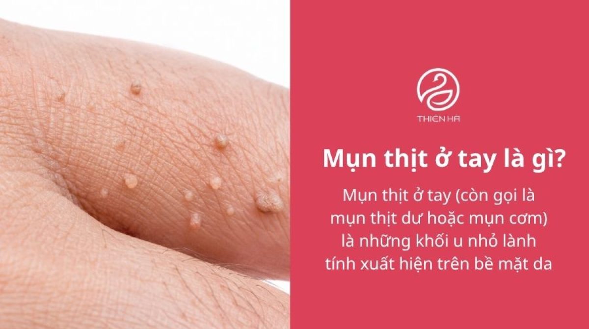 Mụn thịt ở tay: Nguyên nhân, cách nhận biết và phương pháp điều trị hiệu quả