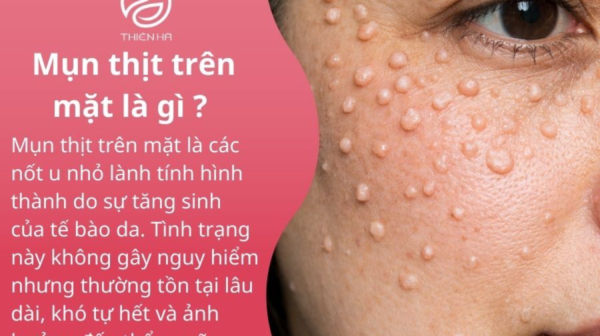 Mụn thịt trên mặt: Nguyên nhân, dấu hiệu và phương pháp xử lý an toàn