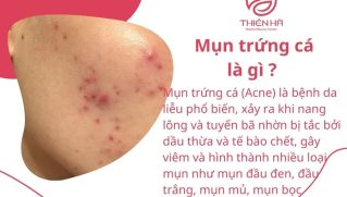 Mụn trứng cá là gì ? Mọi thông tin cần biết và cách điều trị hiệu quả