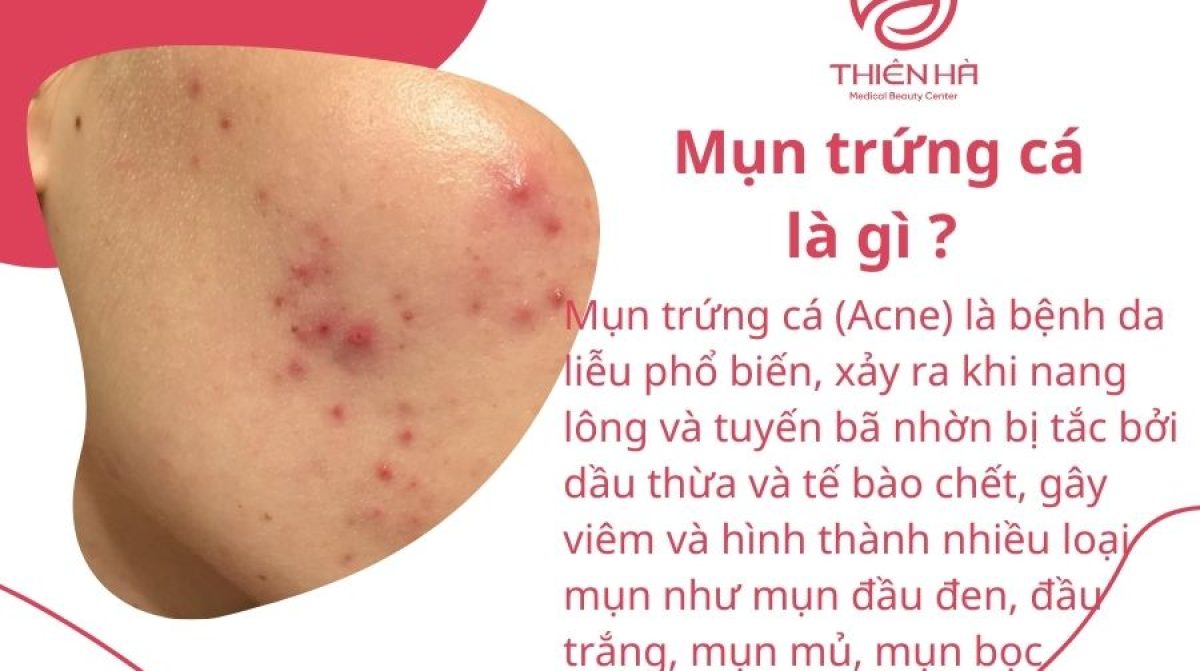 Mụn trứng cá là gì ? Mọi thông tin cần biết và cách điều trị hiệu quả