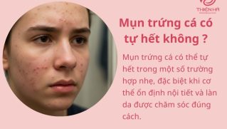 Mụn trứng cá có tự hết không? Nhận biết, xử lý và tư vấn tại Thiên Hà