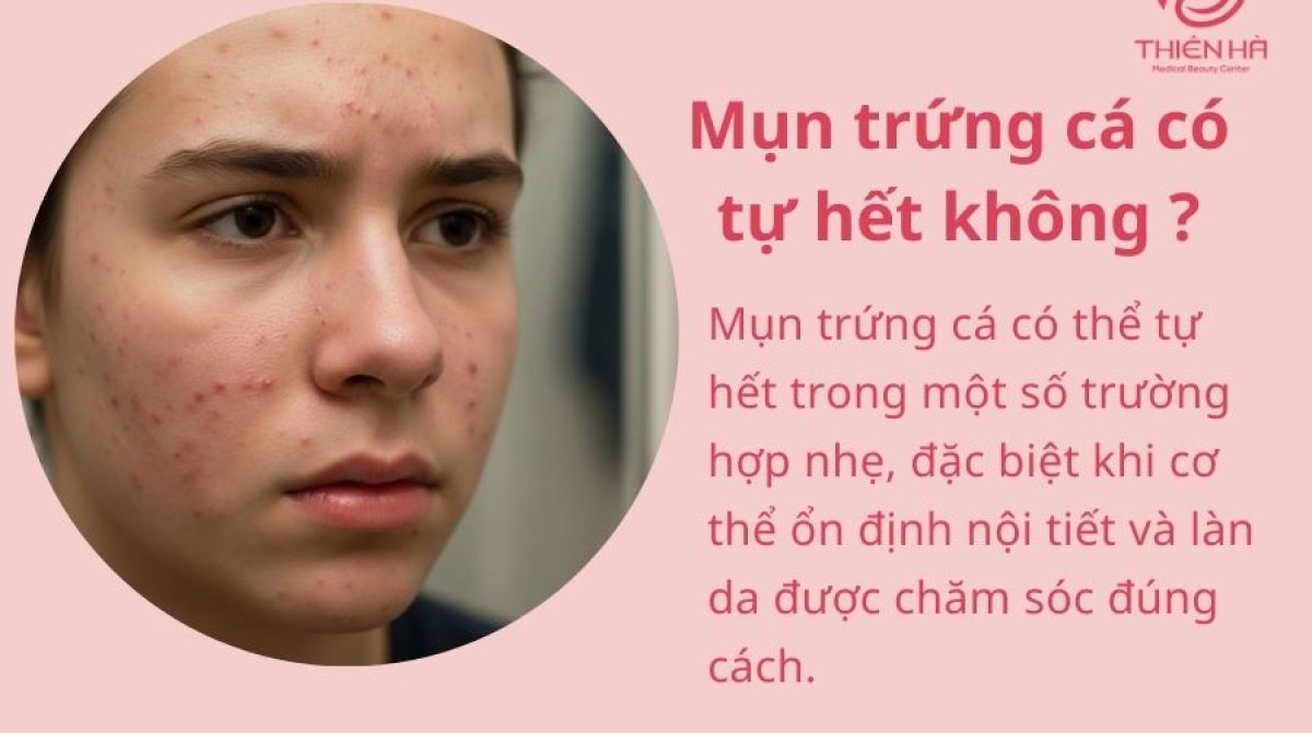 Mụn trứng cá có tự hết không? Nhận biết, xử lý và tư vấn tại Thiên Hà