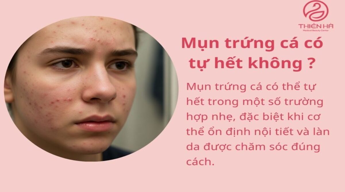 Mụn trứng cá có tự hết không? Nhận biết, xử lý và tư vấn tại Thiên Hà