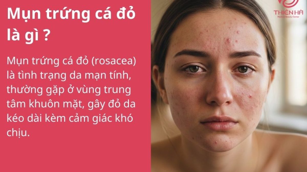 Mụn trứng cá đỏ: Nguyên nhân, dấu hiệu và cách kiểm soát an toàn