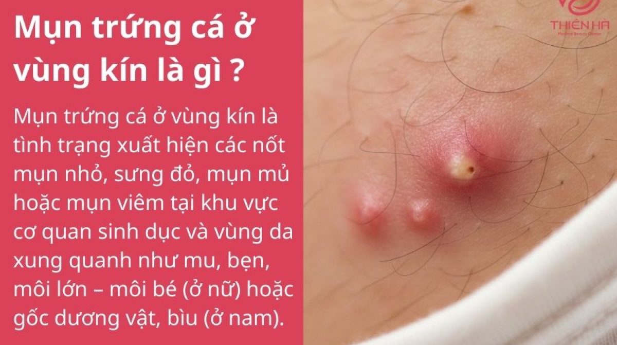 Mụn trứng cá ở vùng kín: Nguyên nhân và cách điều trị an toàn