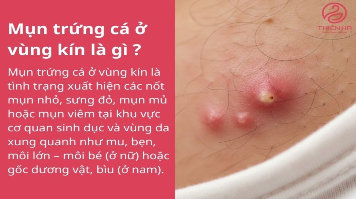 Mụn trứng cá ở vùng kín: Nguyên nhân và cách điều trị an toàn