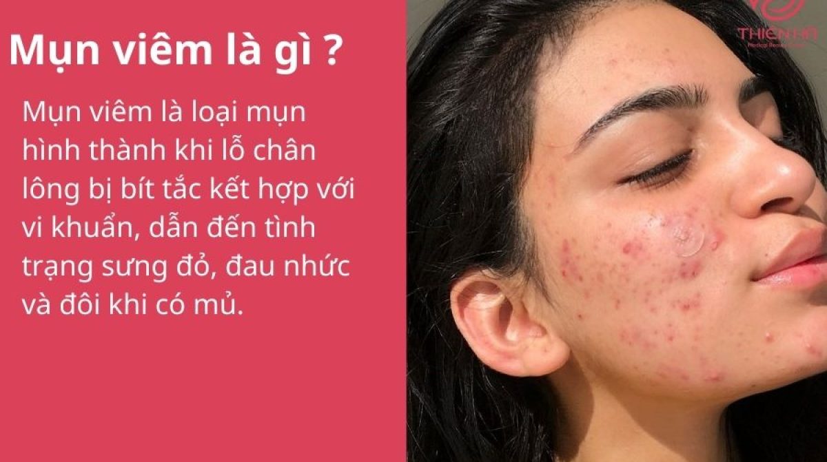 Mụn viêm là gì? Nguyên nhân, dấu hiệu nhận biết và cách điều trị hiệu quả