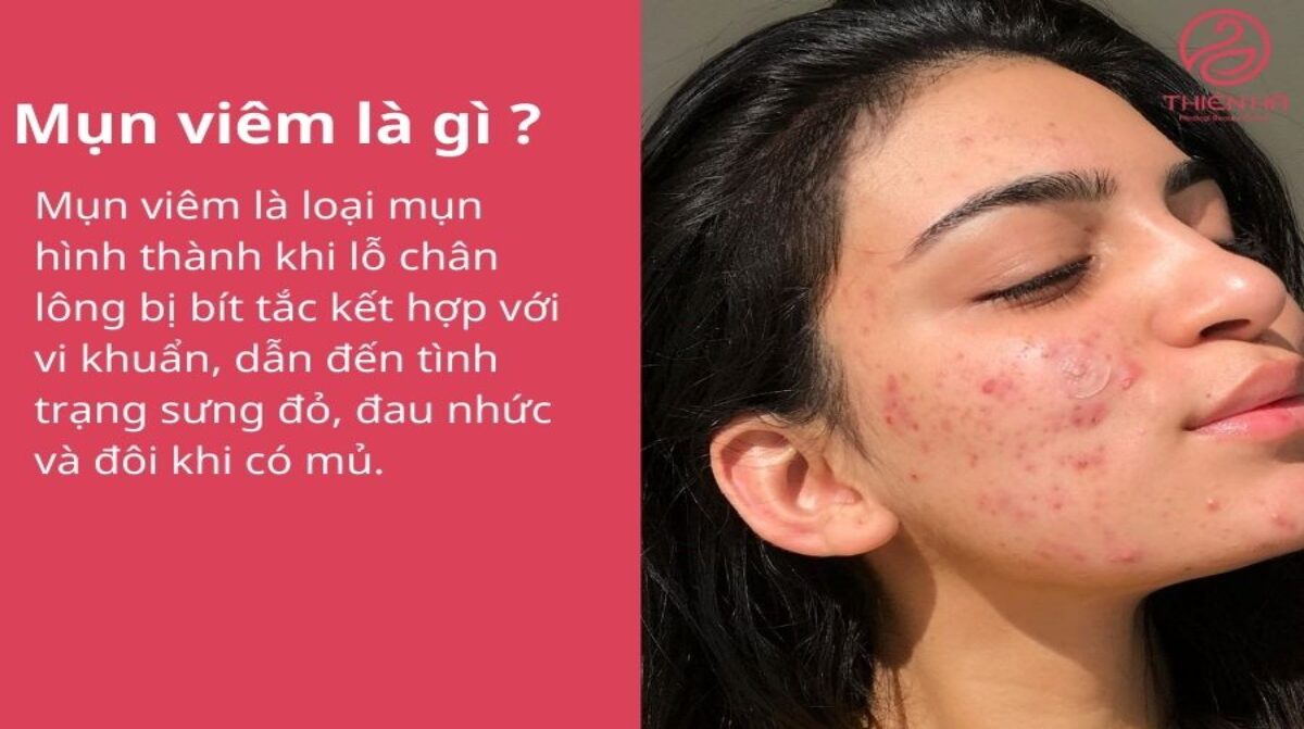 Mụn viêm là gì? Nguyên nhân, dấu hiệu nhận biết và cách điều trị hiệu quả