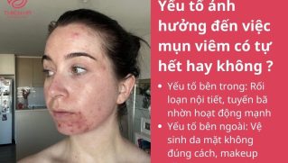 Mụn viêm có tự hết không? Khi nào cần điều trị để tránh thâm sẹo