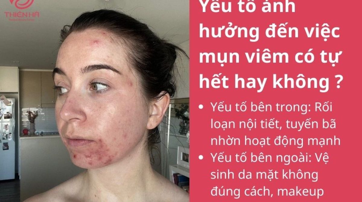 Mụn viêm có tự hết không? Khi nào cần điều trị để tránh thâm sẹo