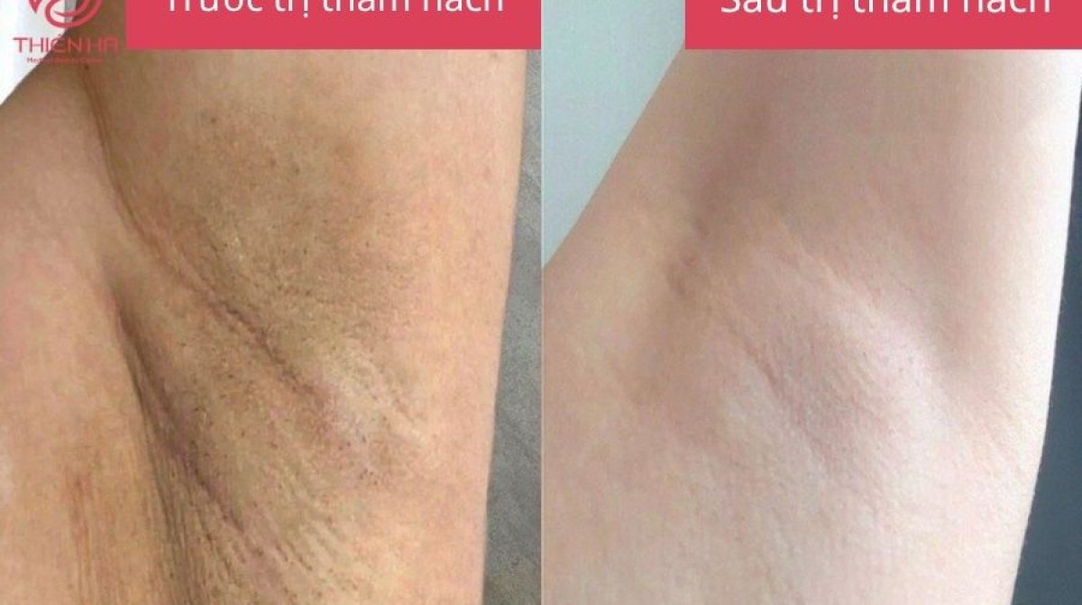 Nách thâm: Nguyên nhân, cách khắc phục nhanh & an toàn cho da dưới cánh tay