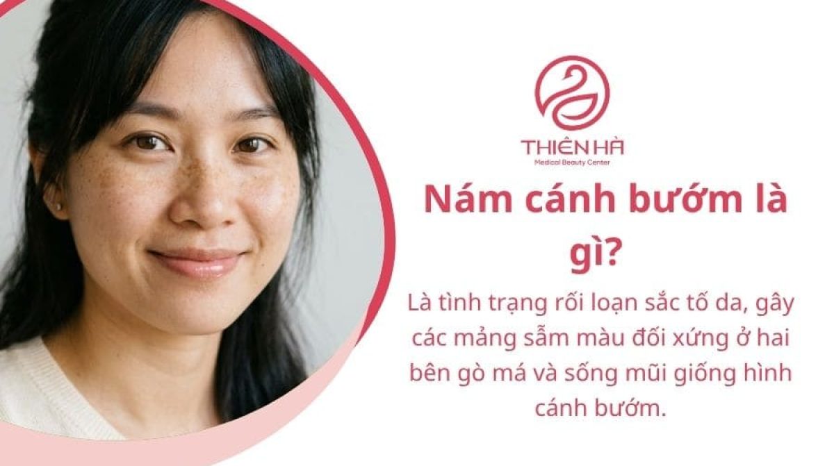 Nám cánh bướm là gì? Giải đáp A-Z và cách cải thiện hiệu quả