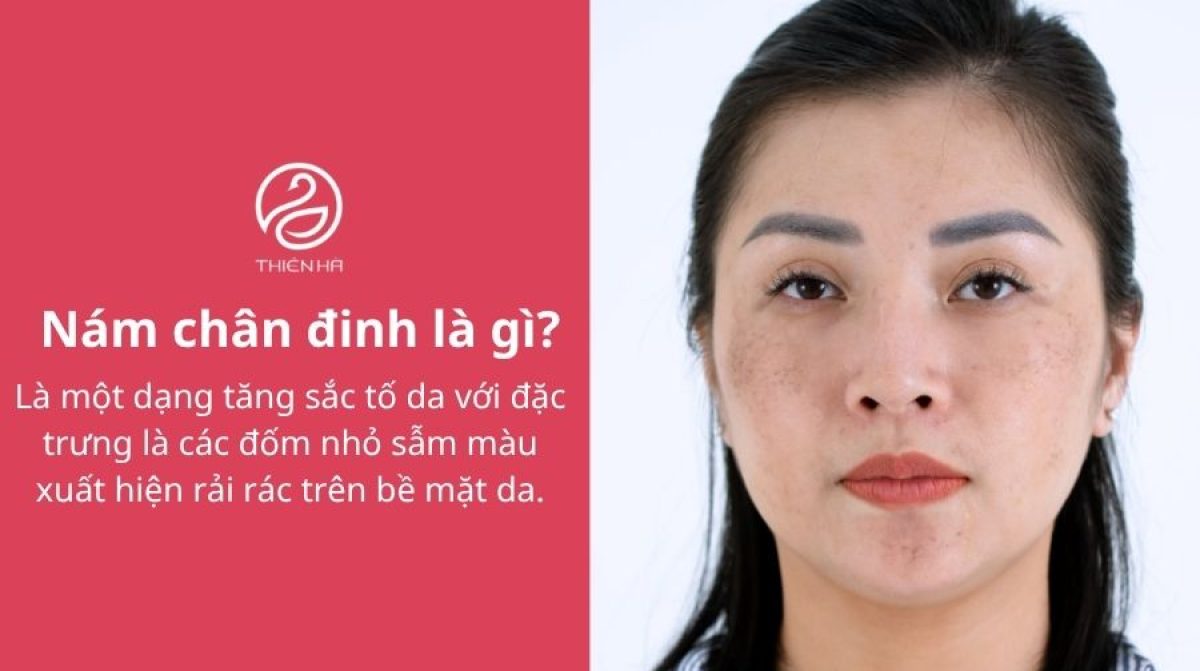 Nám chân đinh là gì? Giải pháp điều trị hiệu quả nhất