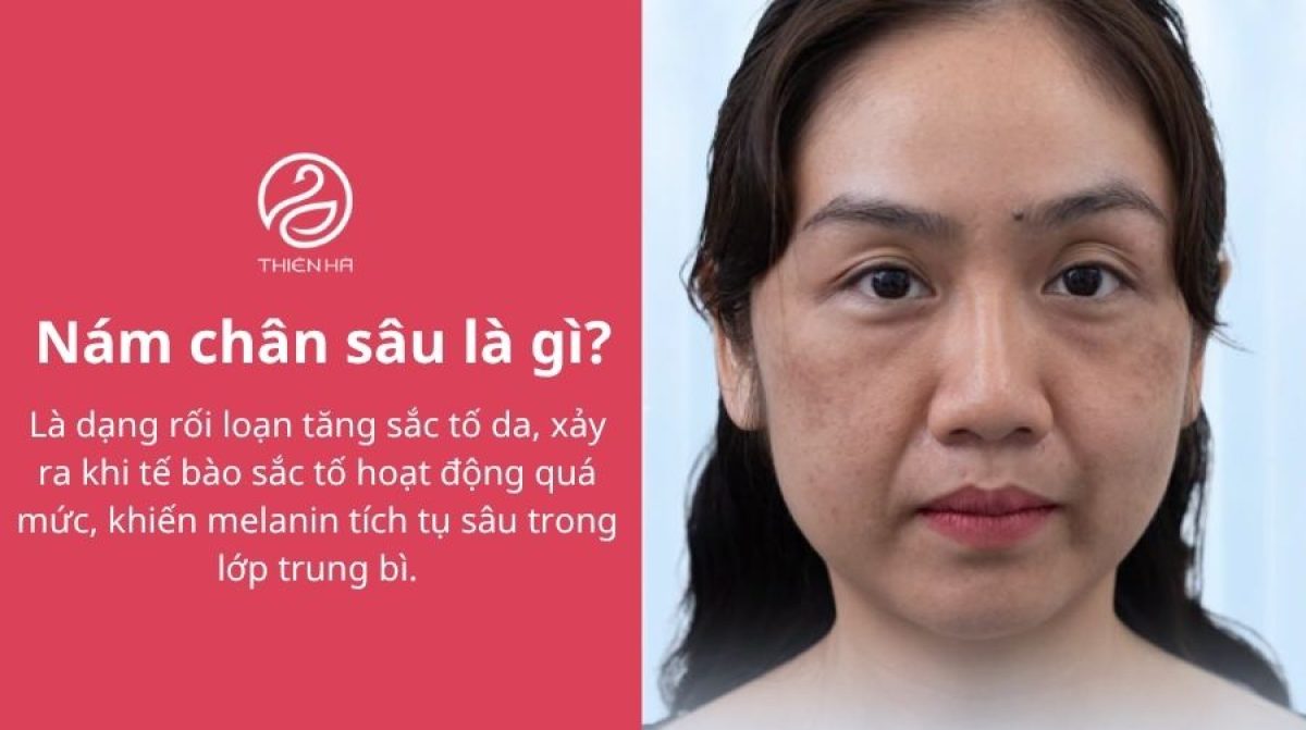 Nám chân sâu: Dấu hiệu nhận biết và cách trị tận gốc