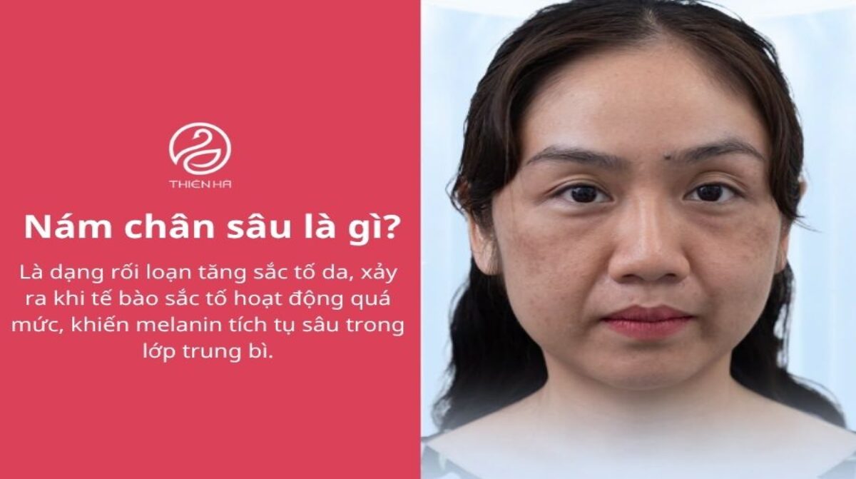 Nám chân sâu: Dấu hiệu nhận biết và cách trị tận gốc