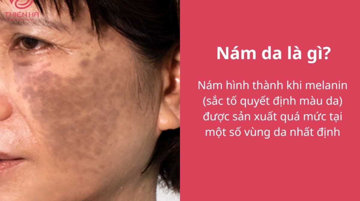 Nám da là gì? Nguyên nhân, các loại, dấu hiệu và cách điều trị
