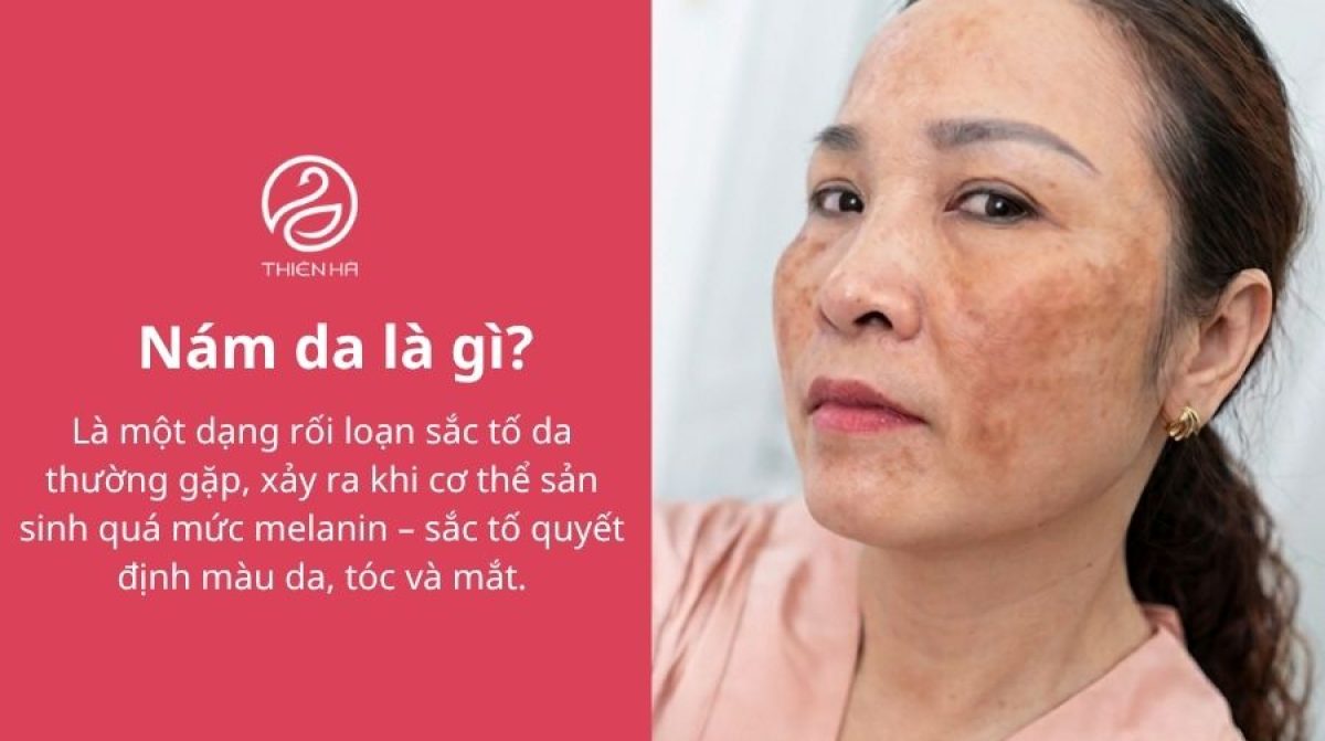 Nám da là gì? Nguyên nhân, các loại, dấu hiệu và cách điều trị