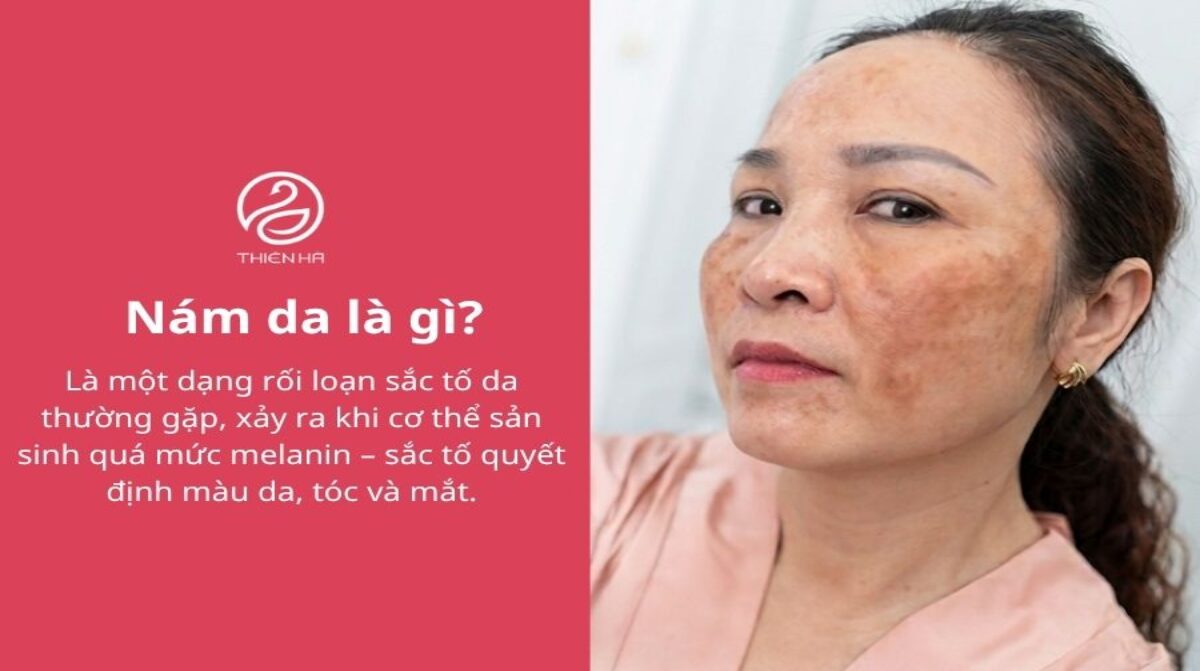 Nám da là gì? Nguyên nhân, các loại, dấu hiệu và cách điều trị