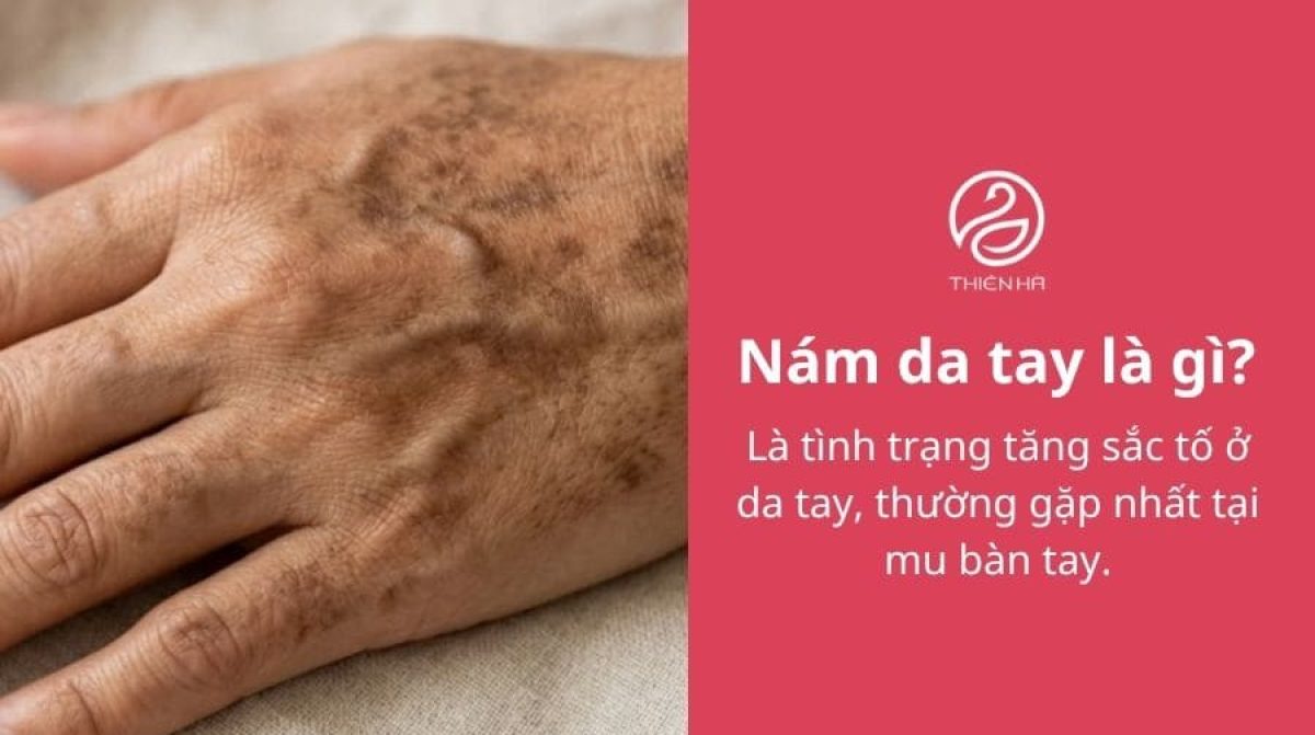 Nám da tay: Dấu hiệu, nguyên nhân và cách khắc phục hiệu quả