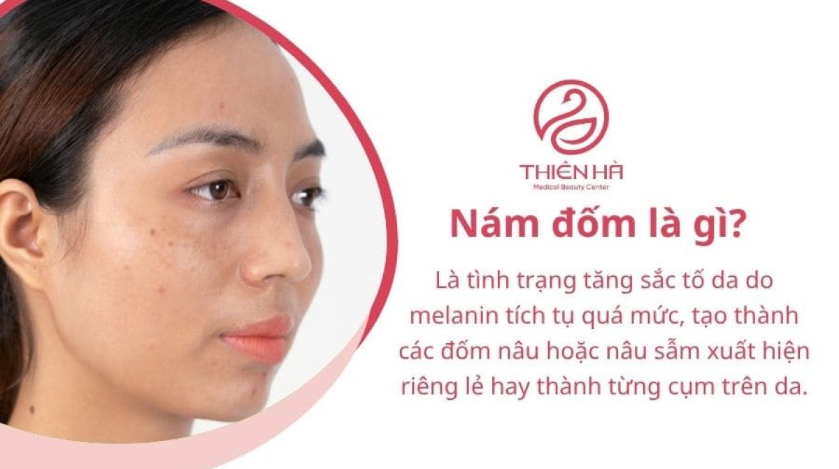 Nám đốm là gì? Nguyên nhân và cách điều trị nám đốm từ A-Z