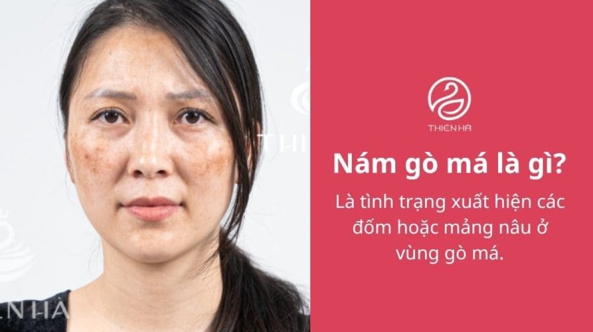 Nám gò má là gì? Nám nhẹ 2 bên gò má có chữa được không?