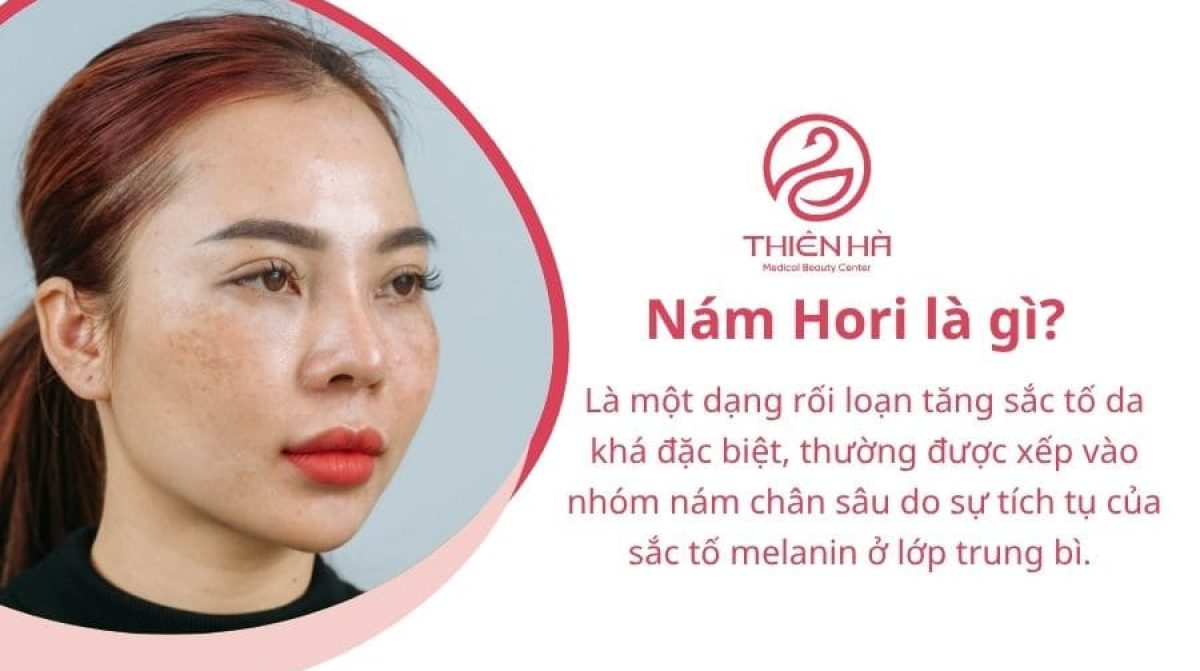 Nám Hori là gì? Giải pháp điều trị nám Hori an toàn, hiệu quả