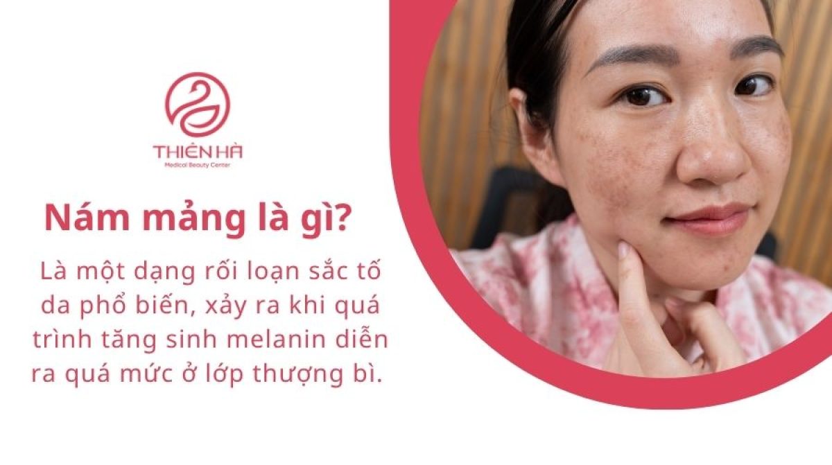 Nám mảng là gì? Cách điều trị và phòng ngừa tái phát