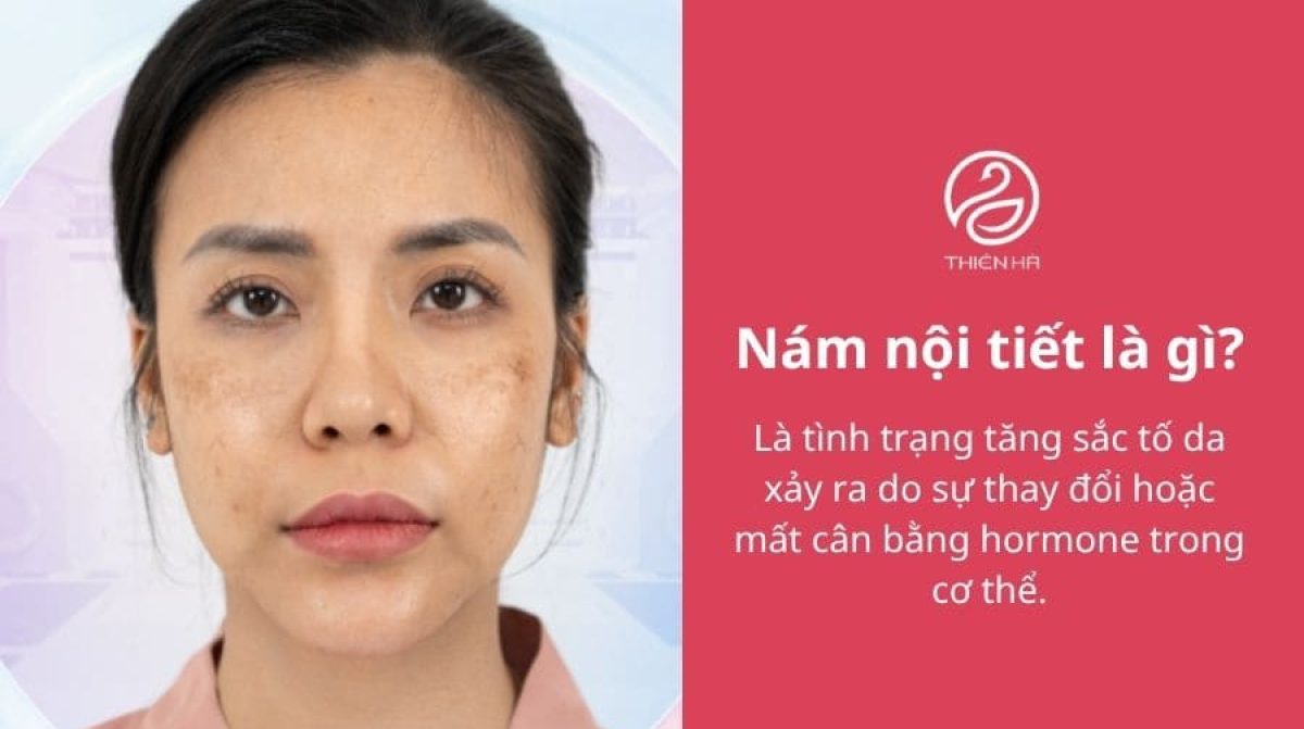 Nám nội tiết là gì? Dấu hiệu và cách điều trị hiệu quả