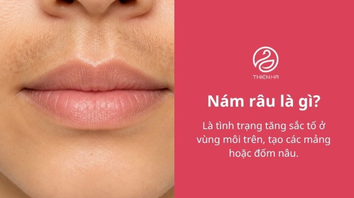 Nám râu là gì? Dấu hiệu và cách điều trị an toàn, hiệu quả