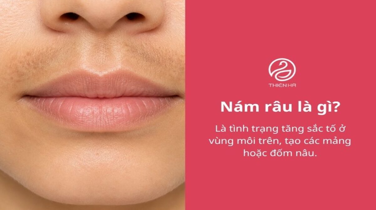 Nám râu là gì? Dấu hiệu và cách điều trị an toàn, hiệu quả