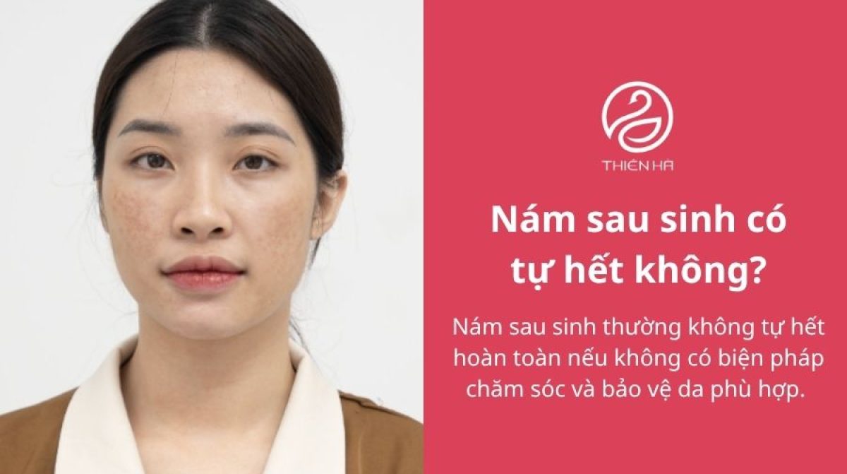 Nám sau sinh có tự hết không? Cách trị an toàn cho mẹ bỉm