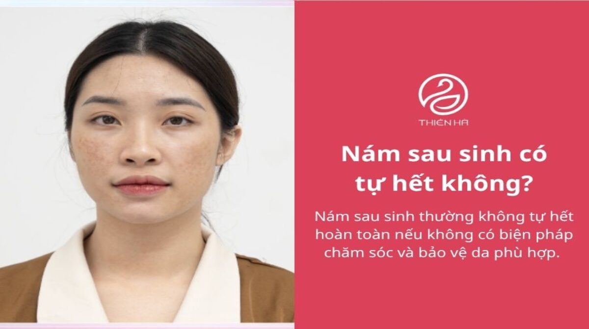 Nám sau sinh có tự hết không? Cách trị an toàn cho mẹ bỉm